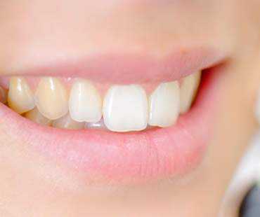 teeth-whitening2.jpg