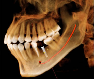 dental-implants-4.jpg