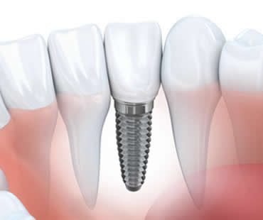 implant-dentistry.jpg