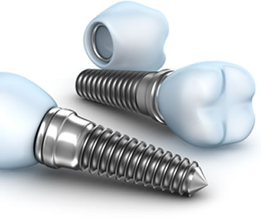 dental-implants-3.jpg