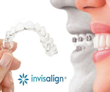invisalgin19.jpg