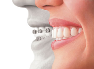 invisalign.jpg