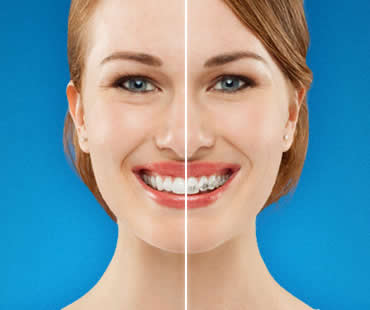 invisalign2.jpg