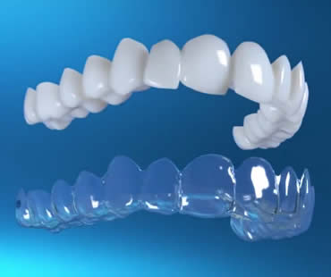 invislaign5.jpg